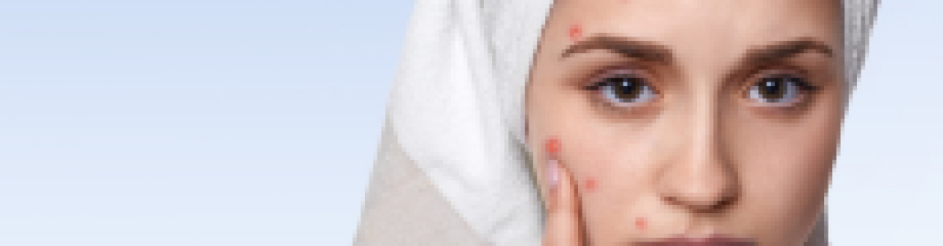 Tips Mengatasi Jerawat Membandel Tanpa Obat Kimia