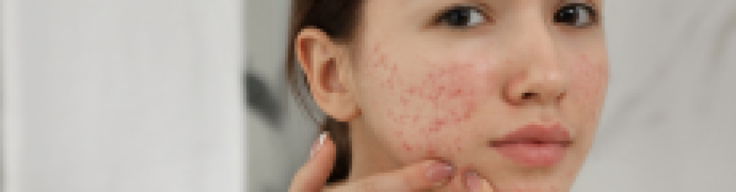 Cara Menghilangkan Bekas Jerawat Dengan Skincare