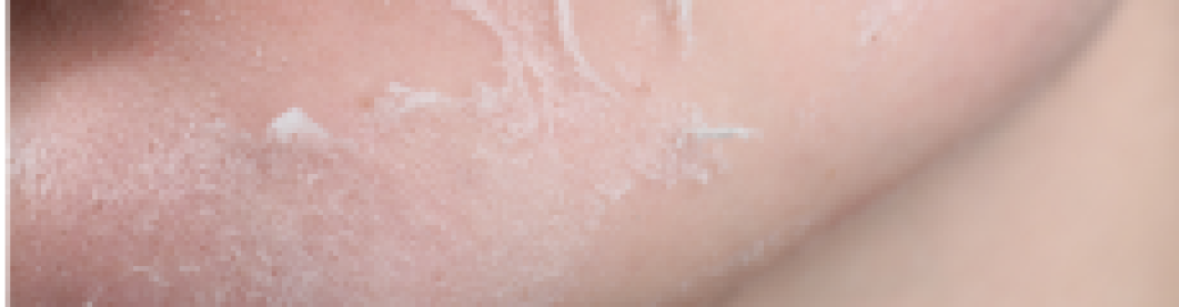 Cara Mengatasi Kulit Mengelupas Dengan Skincare