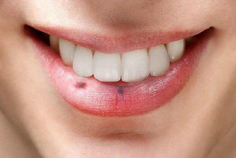 Penyebab Bibir Menjadi Gelap Tanpa Disadari