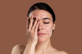 3 Tips Untuk Perawatan Kulit Jerawat