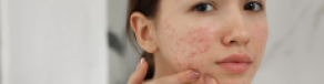 Gambar Artikel Cara Menghilangkan Bekas Jerawat Dengan Skincare