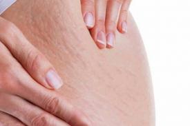 Gambar Artikel 6 Tips Ringan Mengatasi Selulit